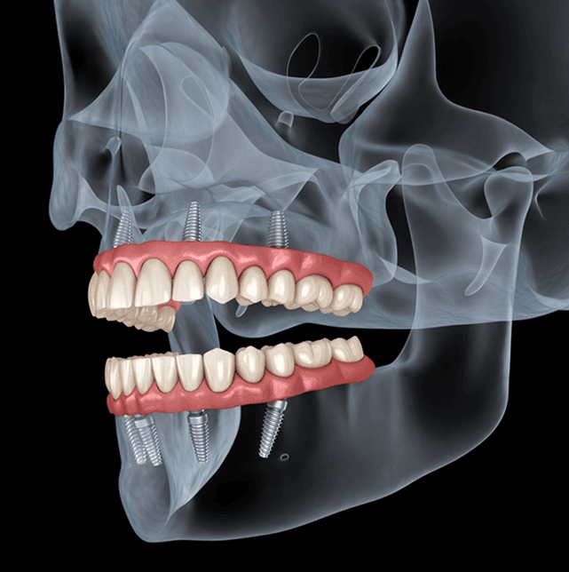 All on x implants.png