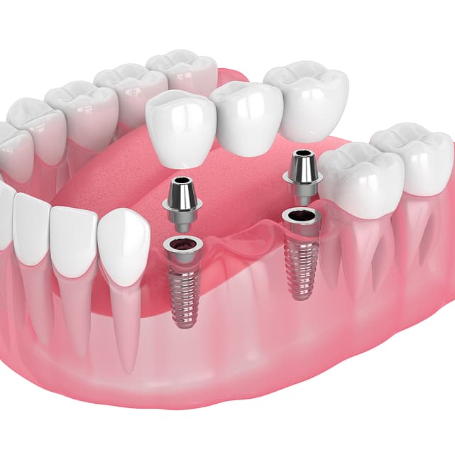 Dental-Crowns-&-Bridges.jpg