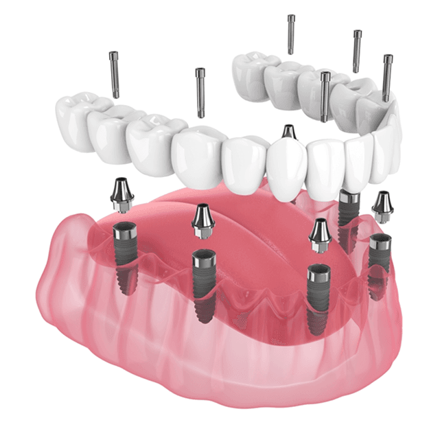 Hybrid implant dentures.png