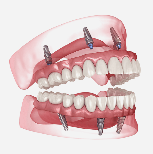 Hybrid-Implant-Dentures.png