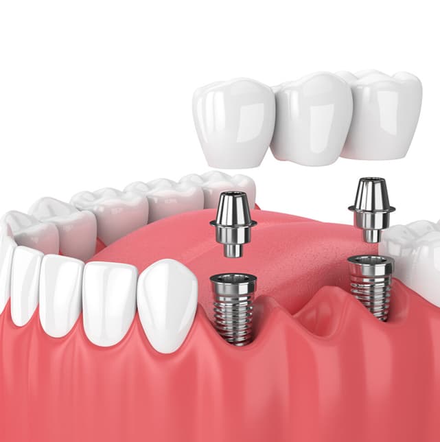 Multiple-tooth-implants.jpg
