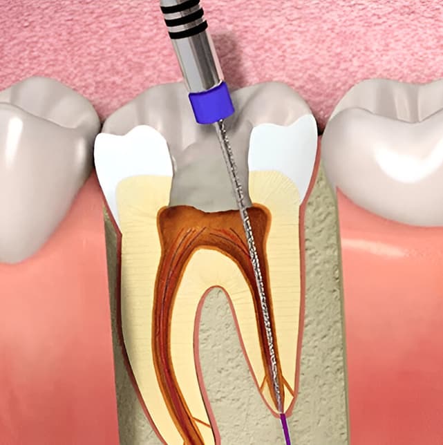 Re-Treatment-of-Failed-Root-Canals.jpg