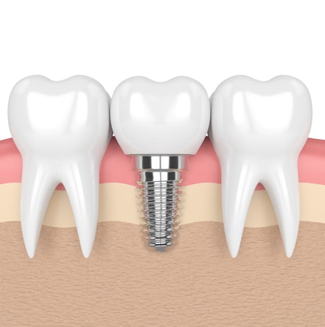 Single-Tooth-Implants.jpg
