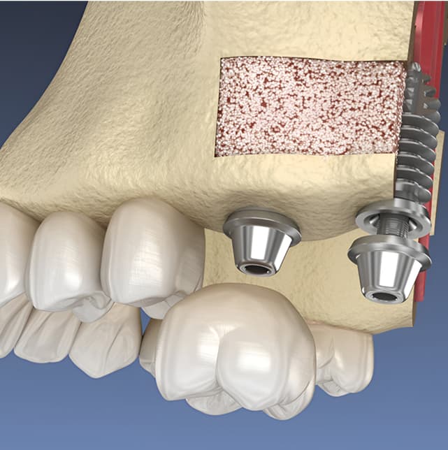bone-grafting-sinus-lift.jpg