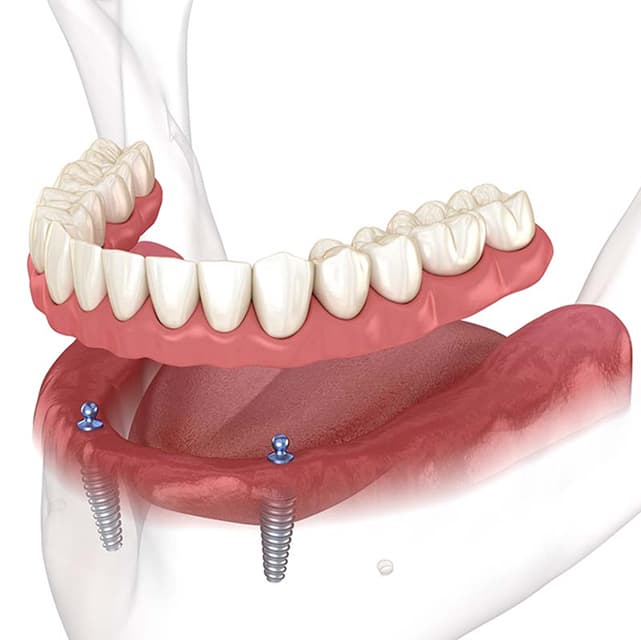 implant-overdentures.jpg