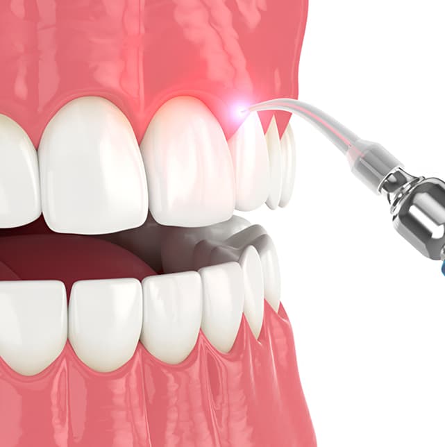 laser-gum-therapy.jpg