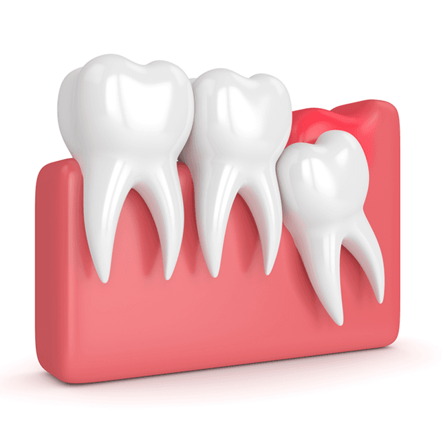 wisdom-teeth-removal.png