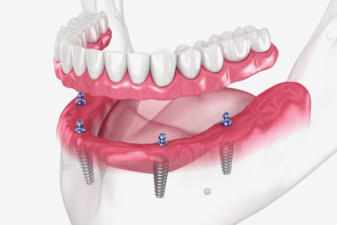 Hybrid-Implant-Dentures.png