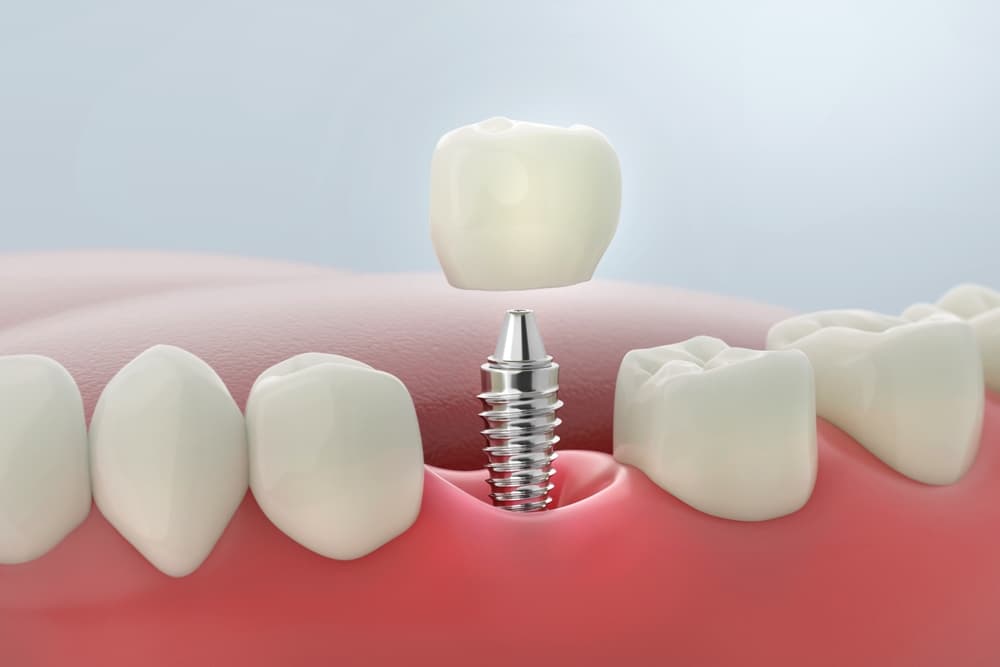 Single-Tooth-Implants.jpg